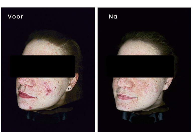 Acne - microneedling - resultaat - Obser520 huidscan - huisanalyse - producten - shop - Vital Skin Clinic - Huidverbetering - Bleiswijk - Lotte