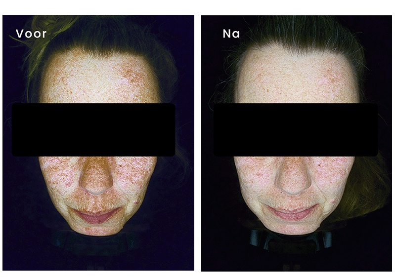 Hyperpigmentatie - microneedling - resultaat - Obser520 huidscan - huisanalyse - producten - shop - Vital Skin Clinic - Huidverbetering - Bleiswijk - Lotte