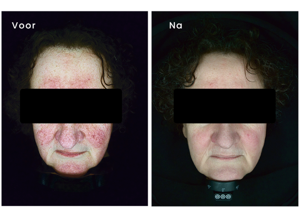 Couperose - microneedling - resultaat - Obser520 huidscan - huisanalyse - producten - shop - Vital Skin Clinic - Huidverbetering - Bleiswijk - Lotte